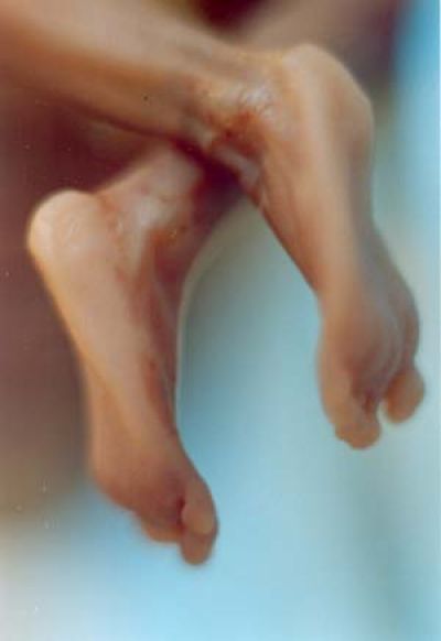 35_aborted_baby